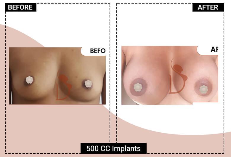 500cc breast implant