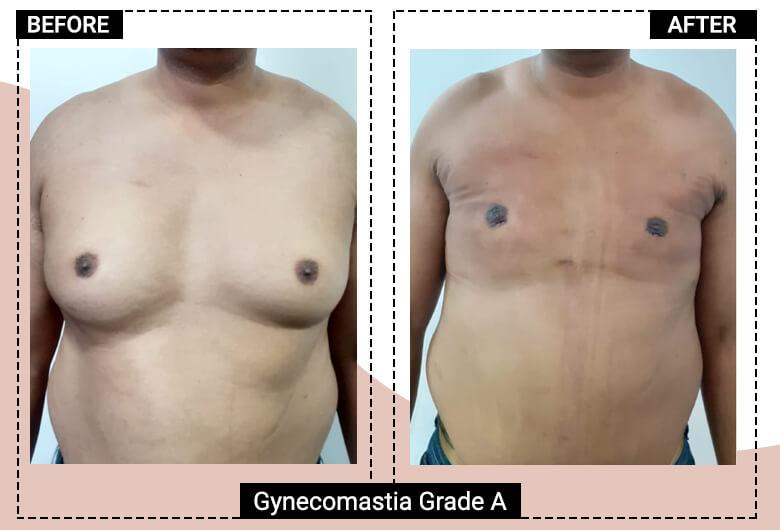 Gynecomastia grade 3a before after