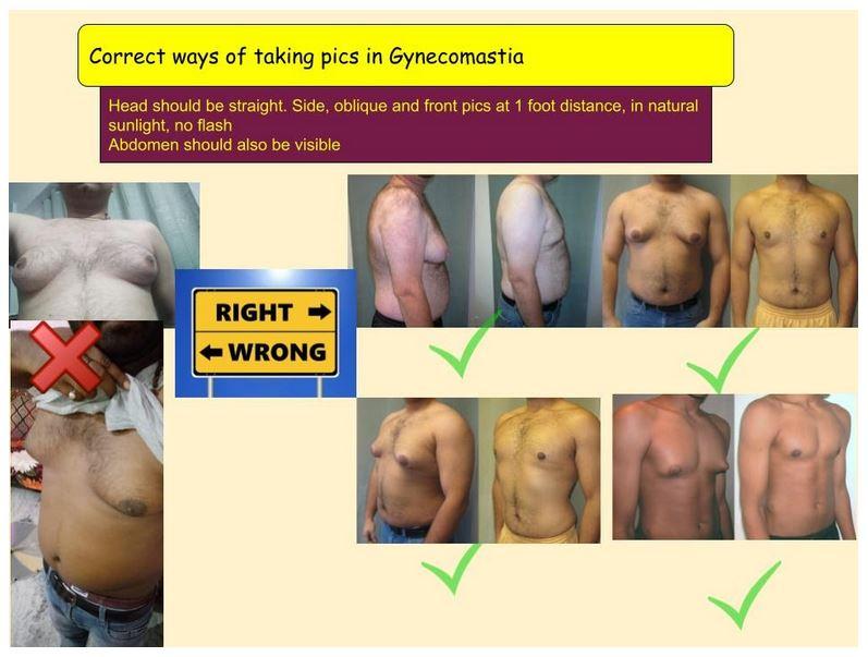 Correct ways of taking pics in gynecomastia