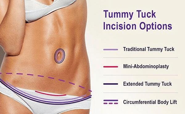 tummy tuck or abdominoplasty incision