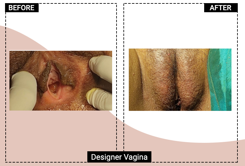 Designer vagina Surgery