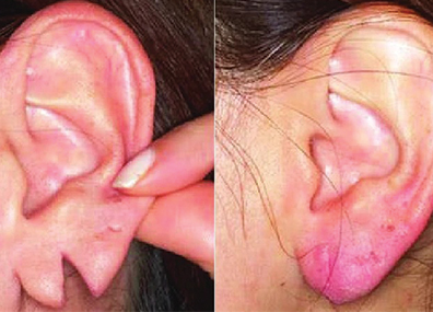 Ear-lobe-repair
