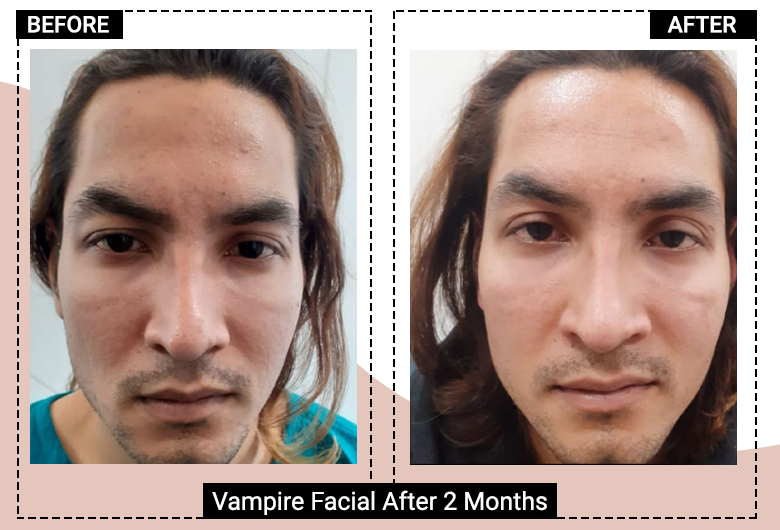 vampire facial result before after