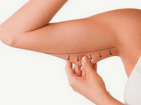 Cost-of-Arm-Lift-Surgery (1)