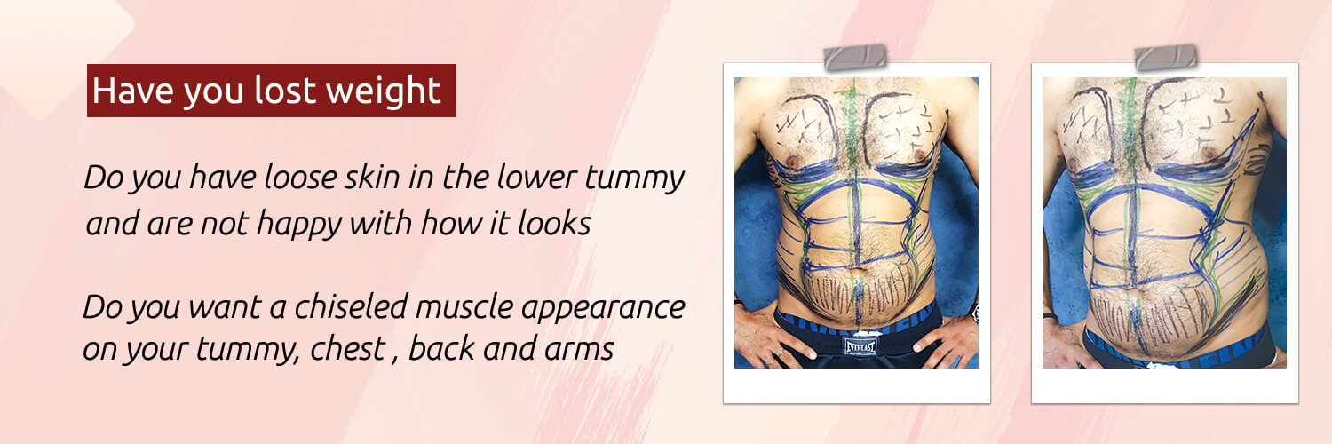What is high definition tummy tuck
