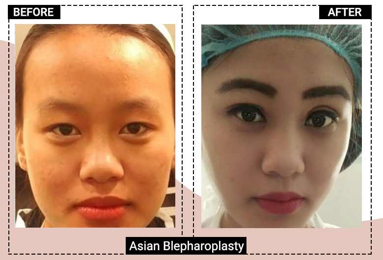 Asian Blepharoplasty