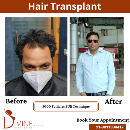 3000 follicles Hair Transplant before after result