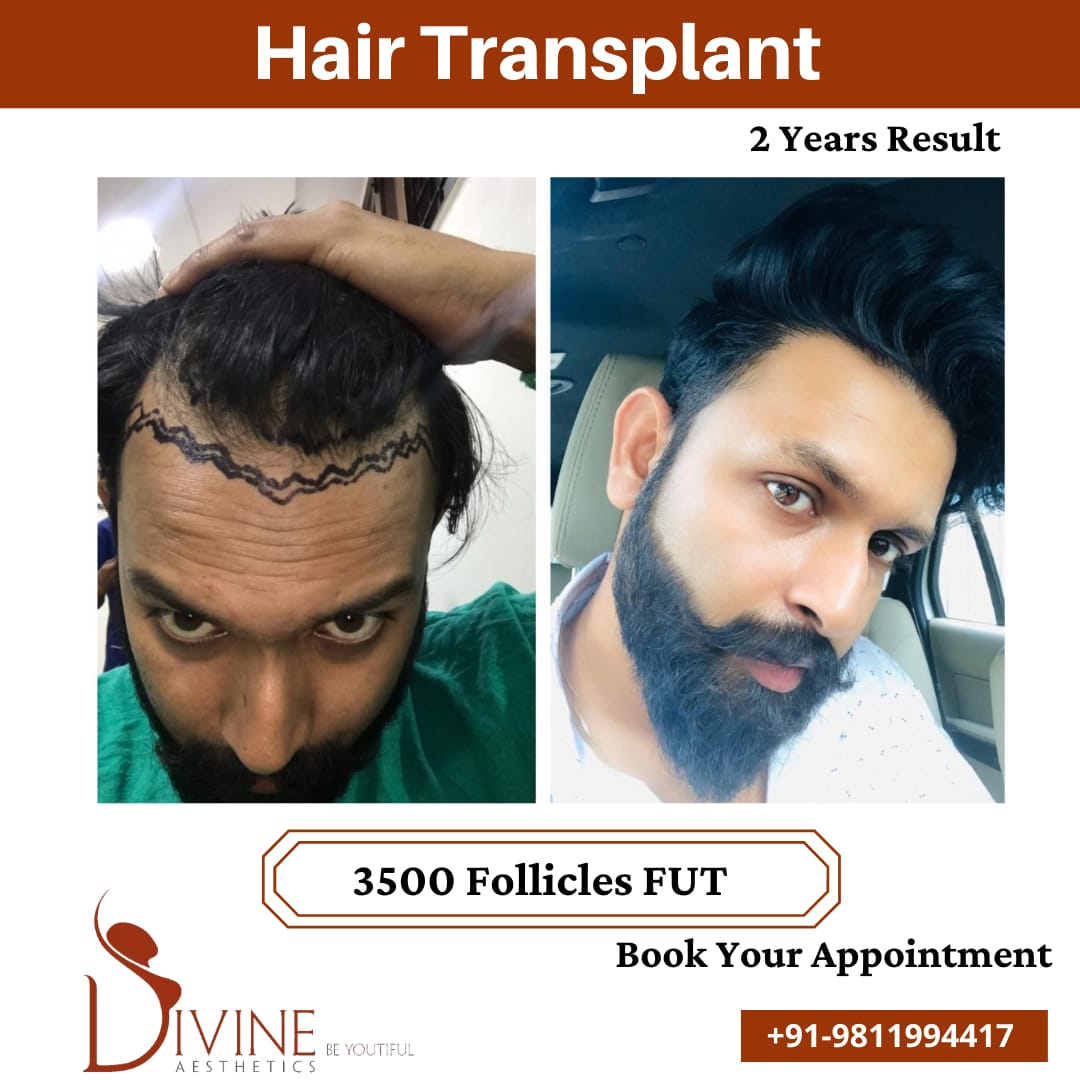 3500 follicles Hair Transplant before after result