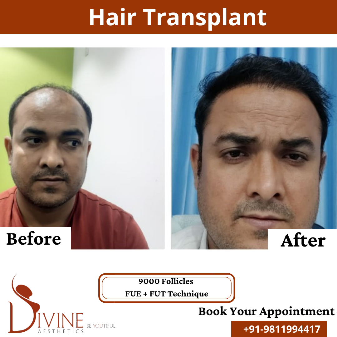 9000 follicles Hair Transplant before after result