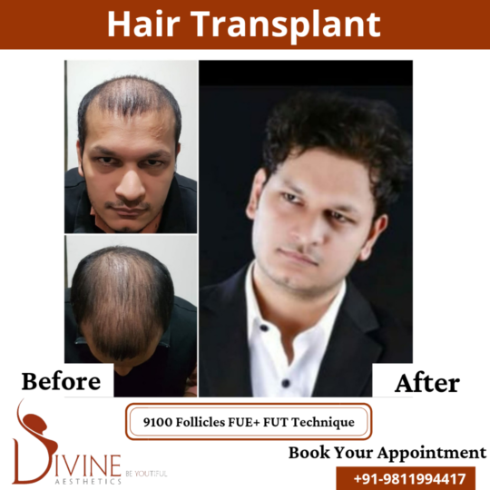 9100 follicles Hair Transplant before after result