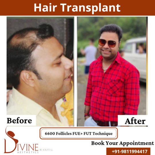 6600 follicles Hair Transplant before after result