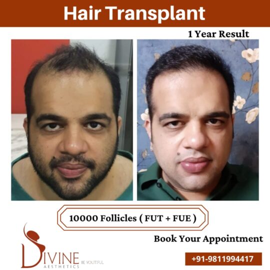 10000 follicles Hair Transplant before after result