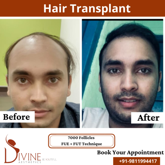 7000 follicles Hair Transplant before after result