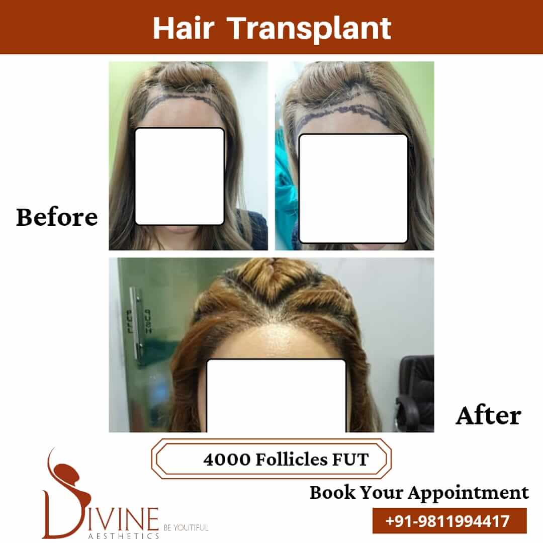 female Hair Transplant before after result