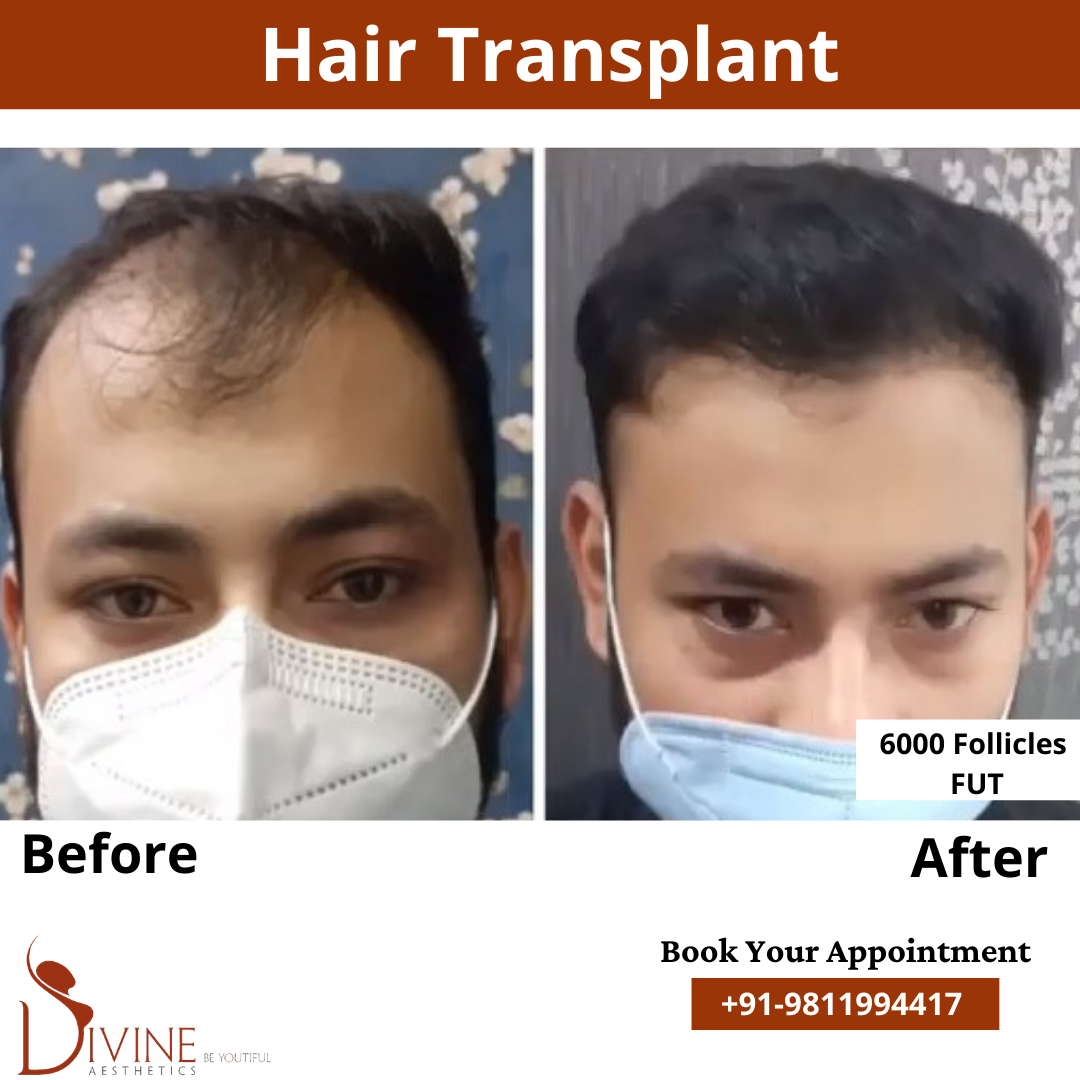 6000 follicles Hair Transplant before after result