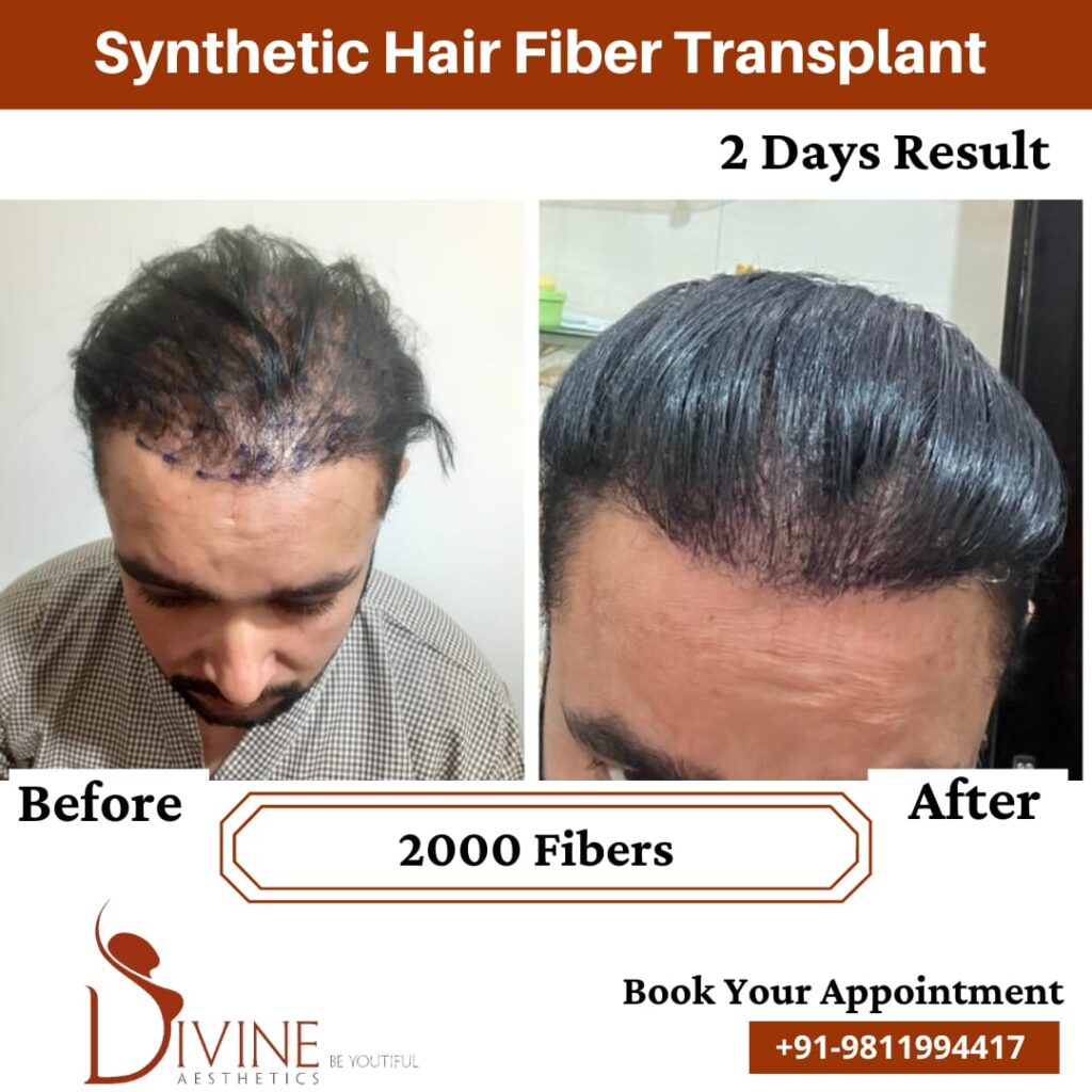 Hair Transplant  Explain The Different Techniques And Their AfterEffects