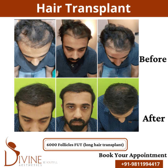 Long Hair Transplant before after result