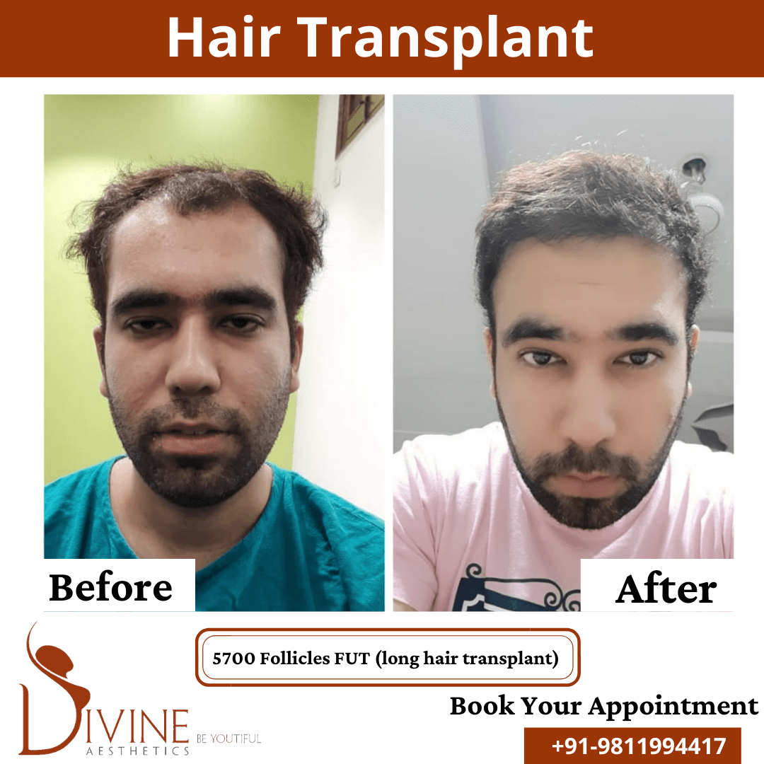 Long Hair Transplant before after result