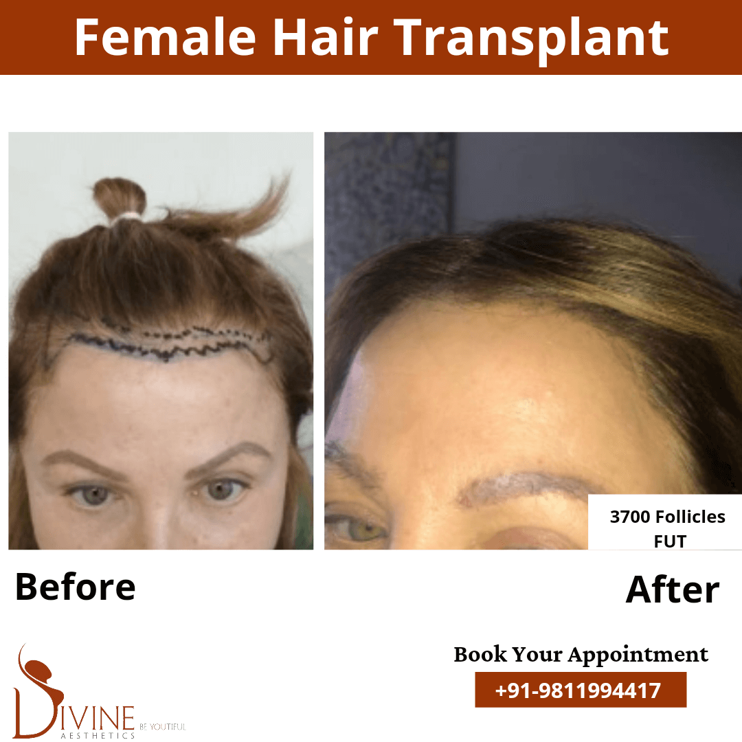 female Hair Transplant before after result