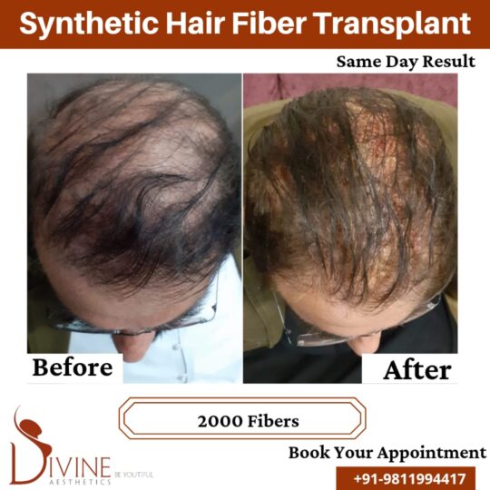 Synthetic Hair Transplant before after result