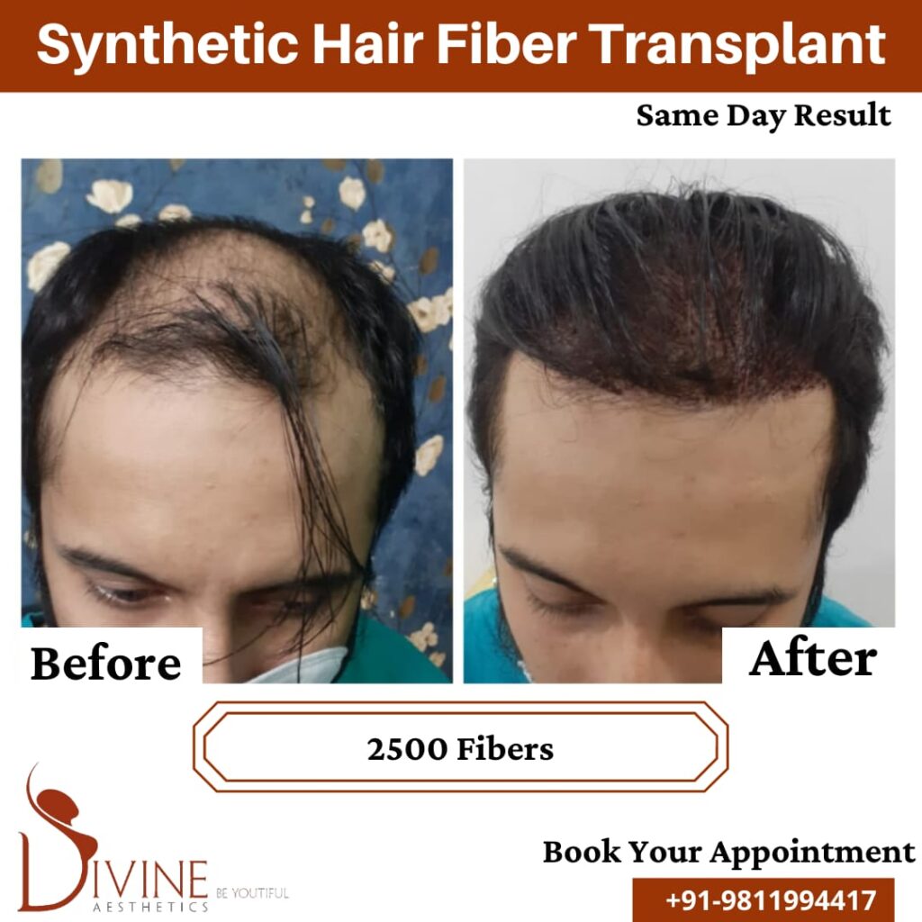 Hair Transplant Cost in India: Current Price Details - IBH