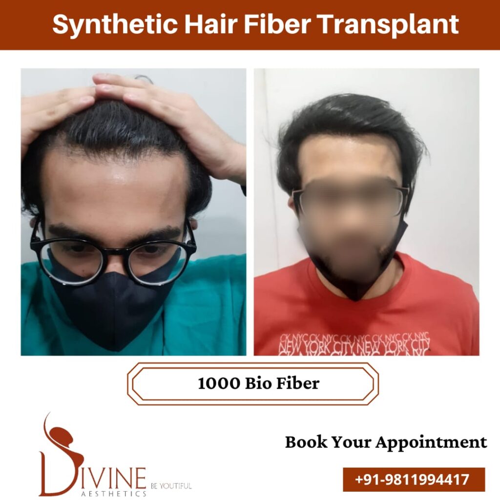 Synthetic (Biofibre) Hair Transplant | Longevita
