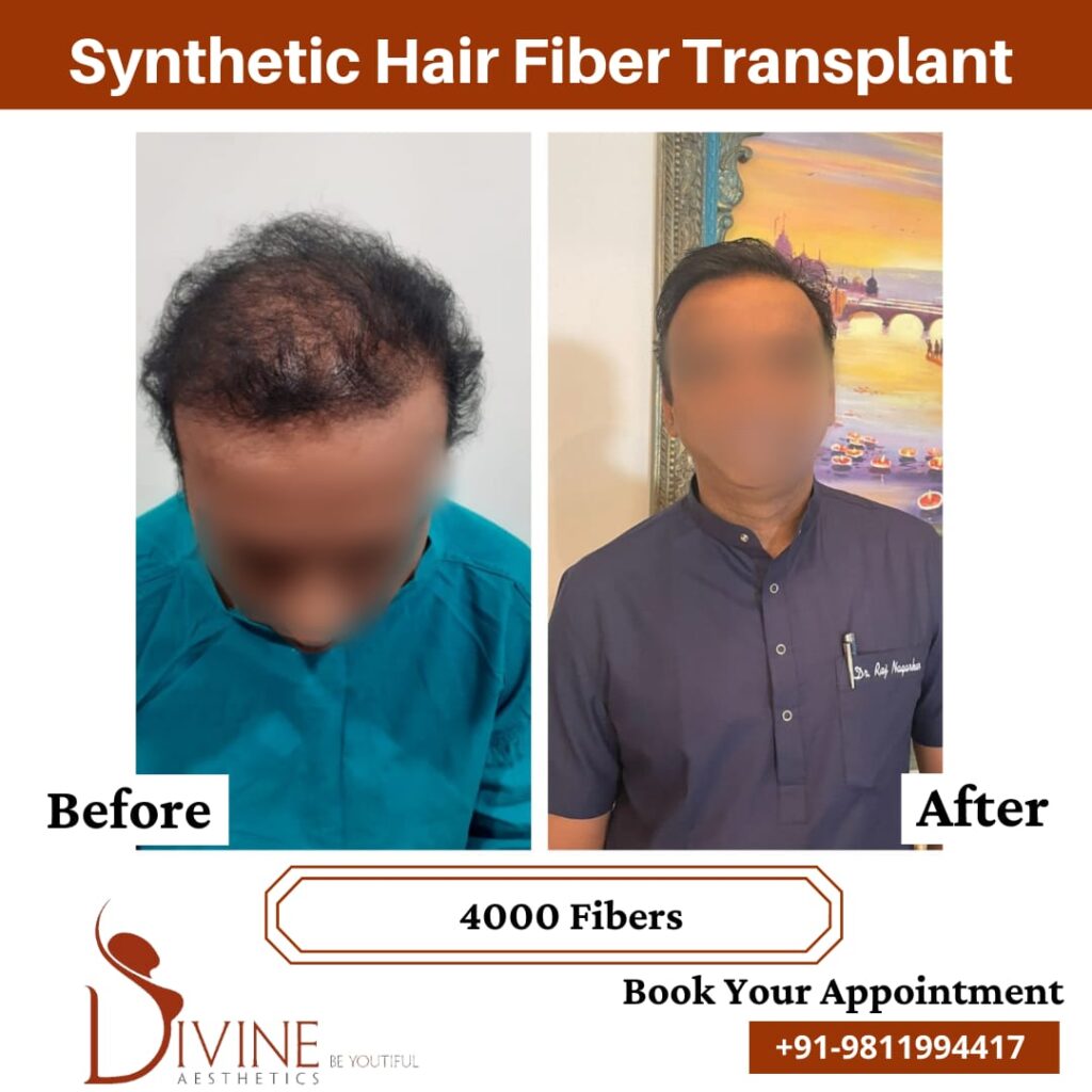 Who Should Undergo Synthetic Hair Transplant | Divine Cosmetic Surgery