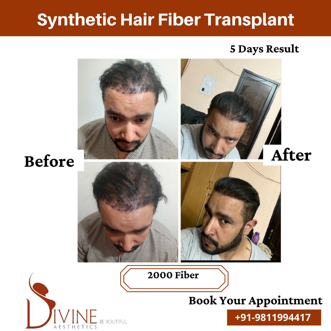 Synthetic Hair Transplant before after result