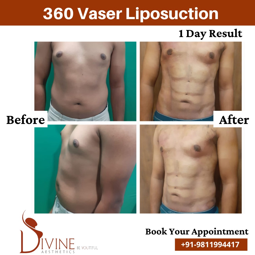 1 Day Result of 360 Vaser Liposuction