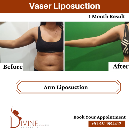 1 Month Result of Arm Liposuction