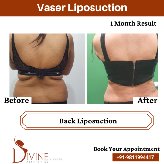 Back Liposuction before after
