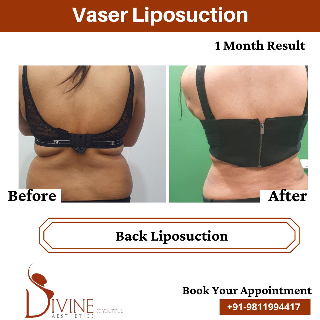1 Month Result of Back Liposuction