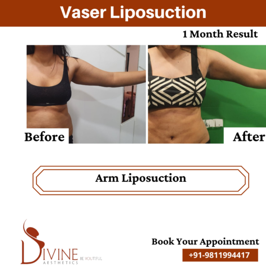 Liposuction before after of front