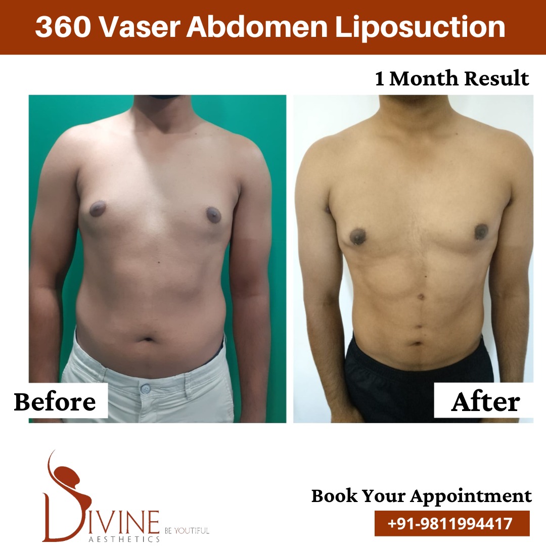 1 Month Result of Vaser Abdomen Liposuction