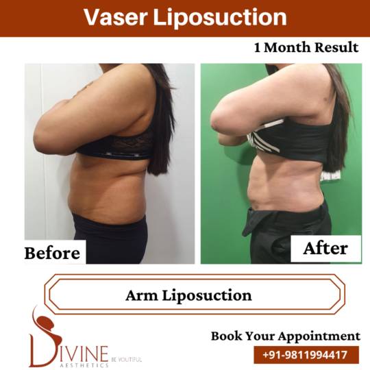 Vaser Liposuction 1 Month Result