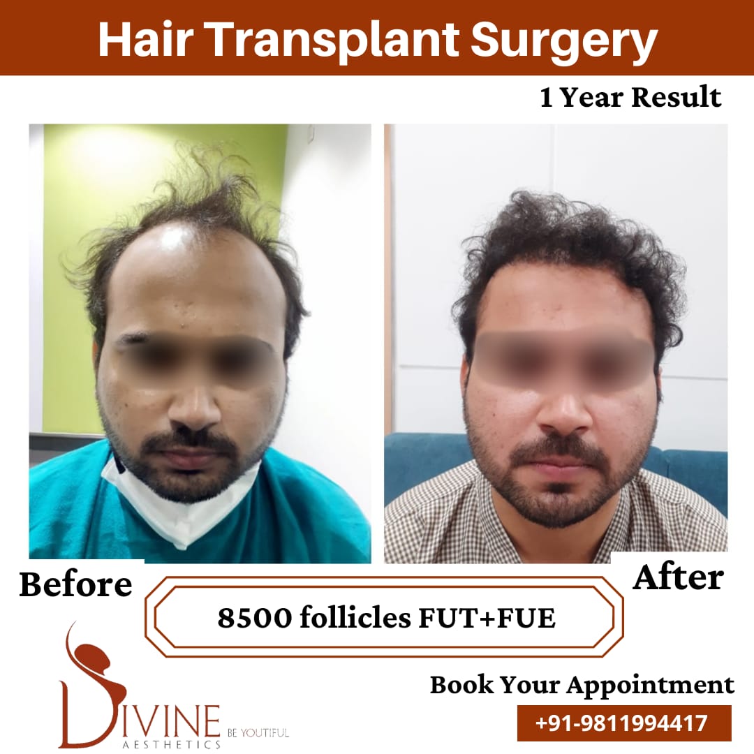1 Year hair transplant before afater