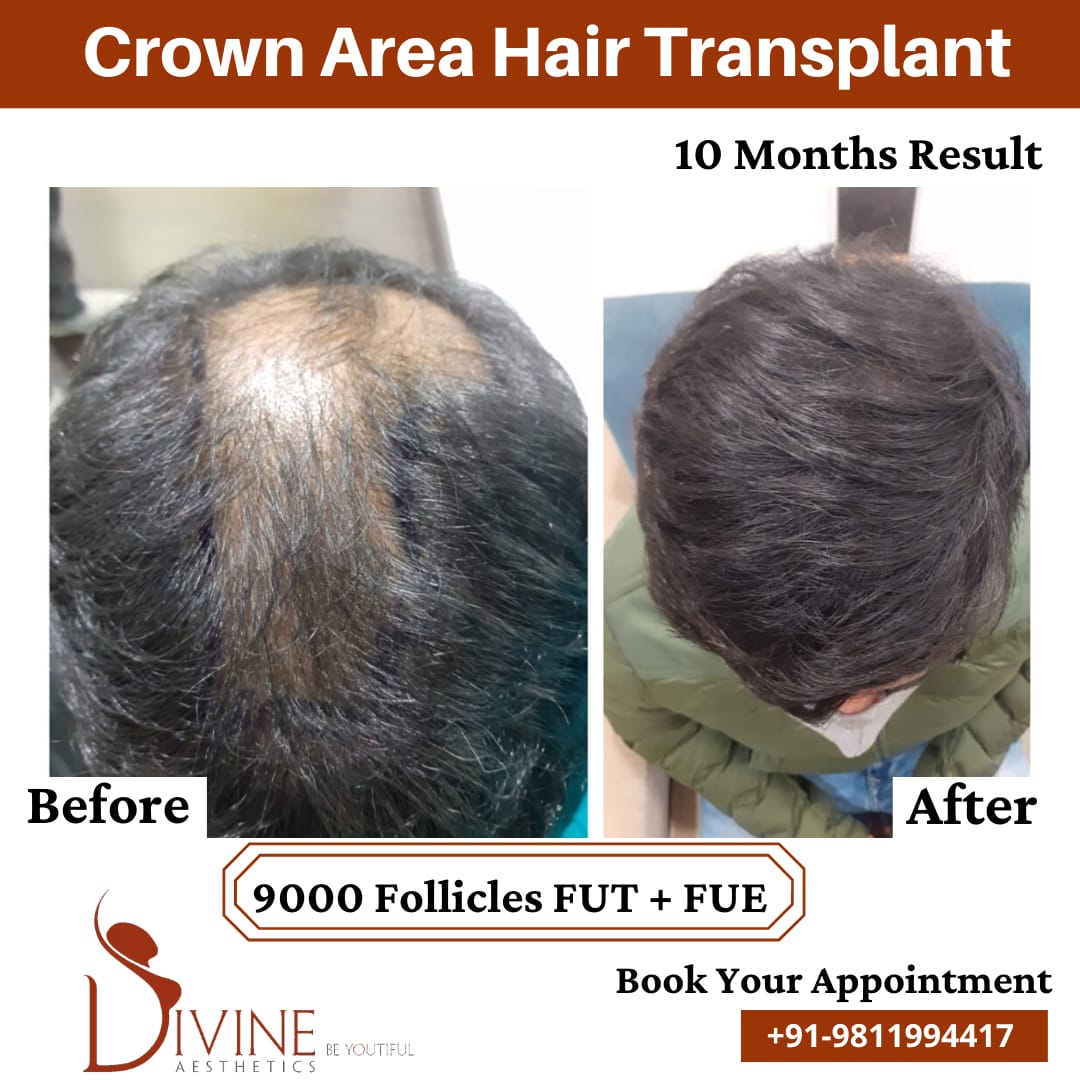 10 Months hair transplant before after
