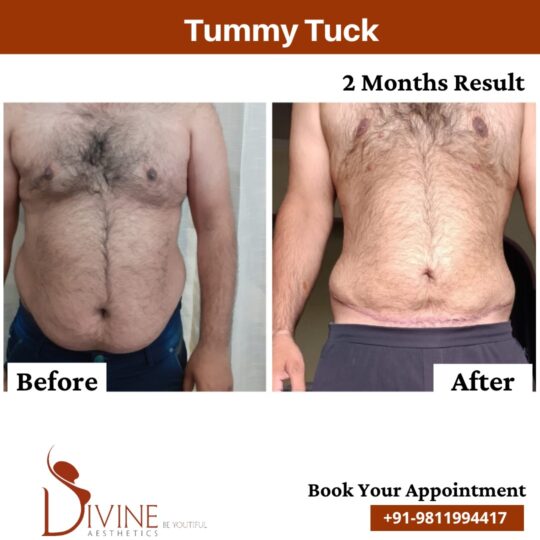After 2 Month Result of Tummy Tuck