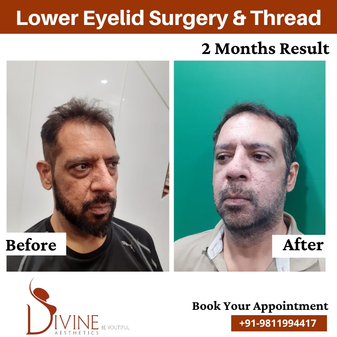 2 Months result of Lower Eyelid Surgery