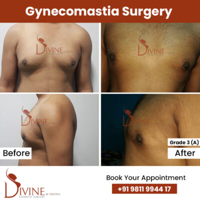 3 (A) Grade Gynecomastia Result