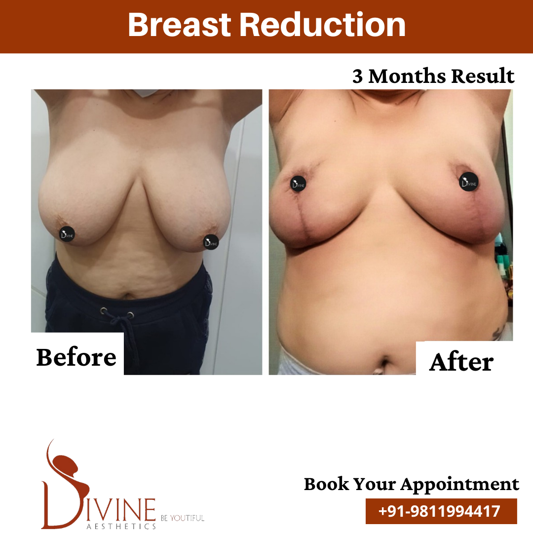 3 Months Result of Breast Reduction