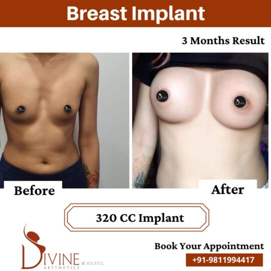 3 Months of Breast Implant Result 320 CC