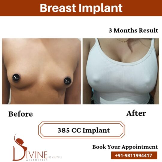 3 Months of Breast Implant Result 385 CC