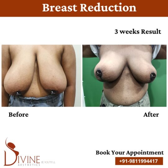 3 Weeks Result of Breast Reduction