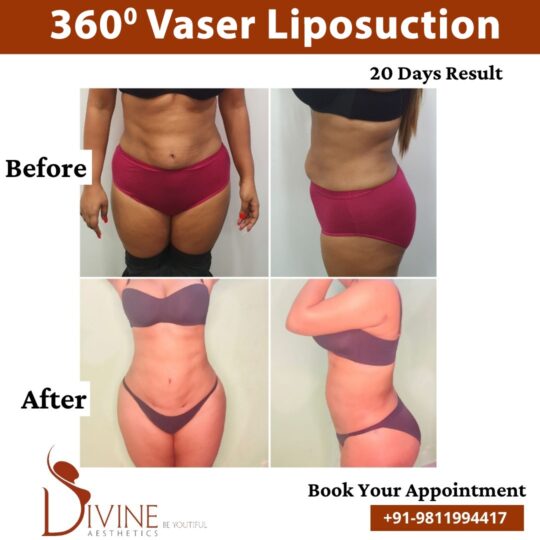 Before and After 360 Vaser Liposuction