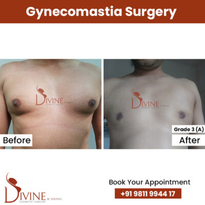 (3)A Grade Gynecomastia Result