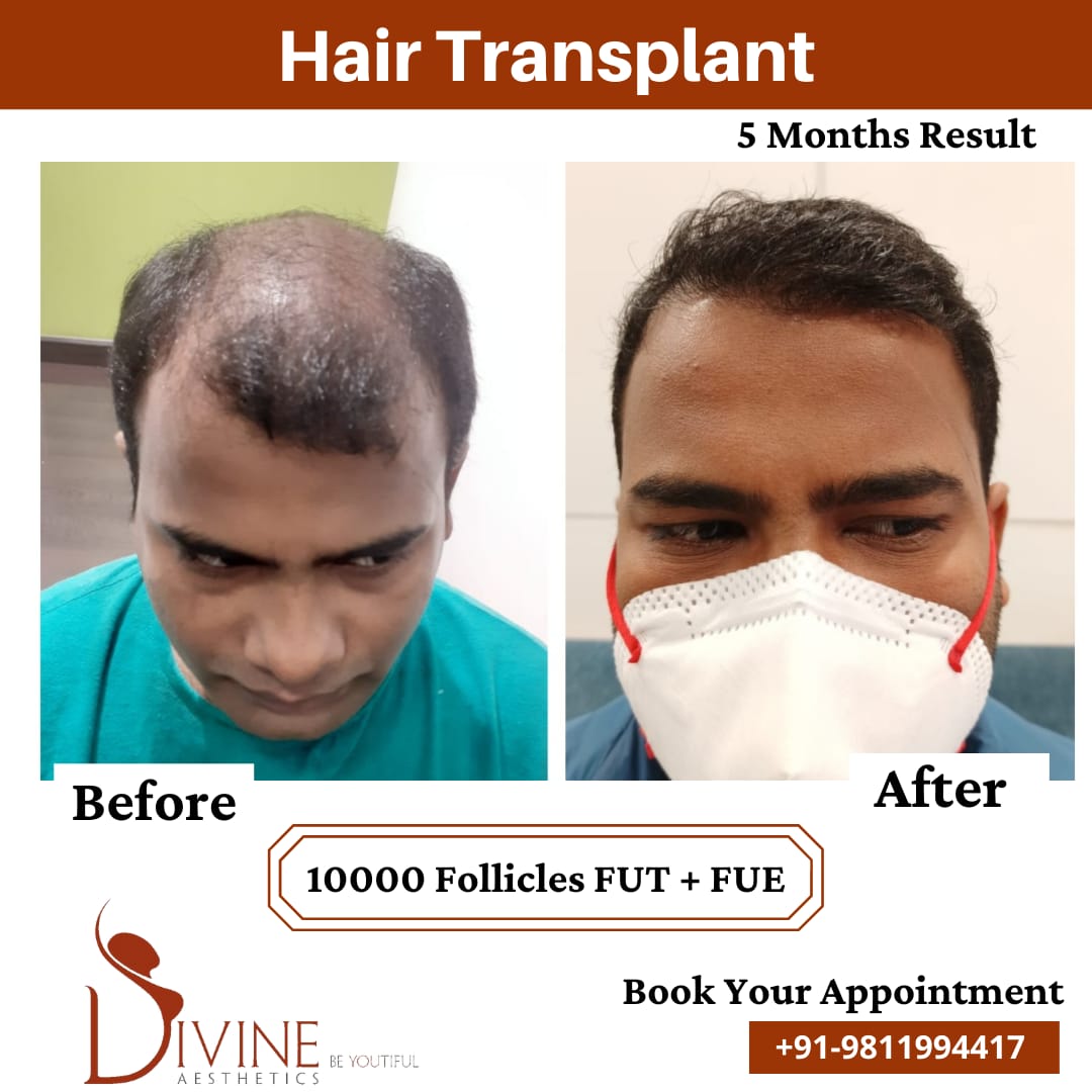 5 Months hair transplant before after