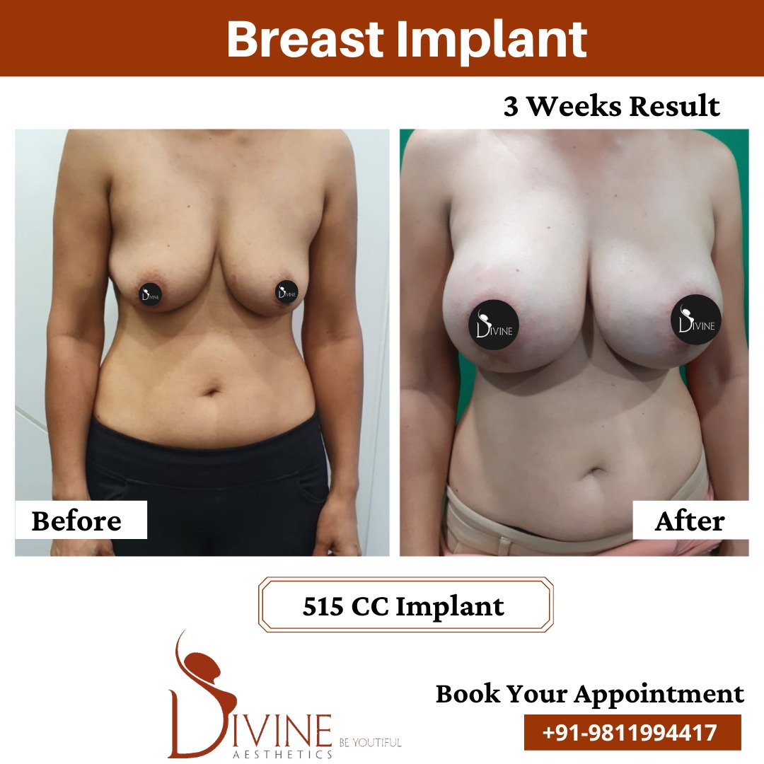 515 CC Breast Implant Result