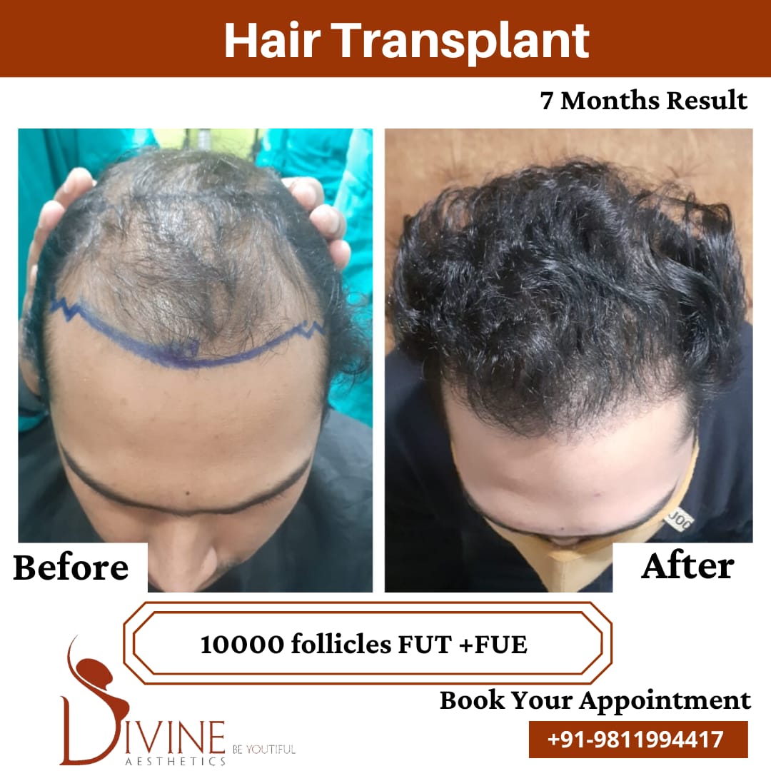7 Months hair transplant before after