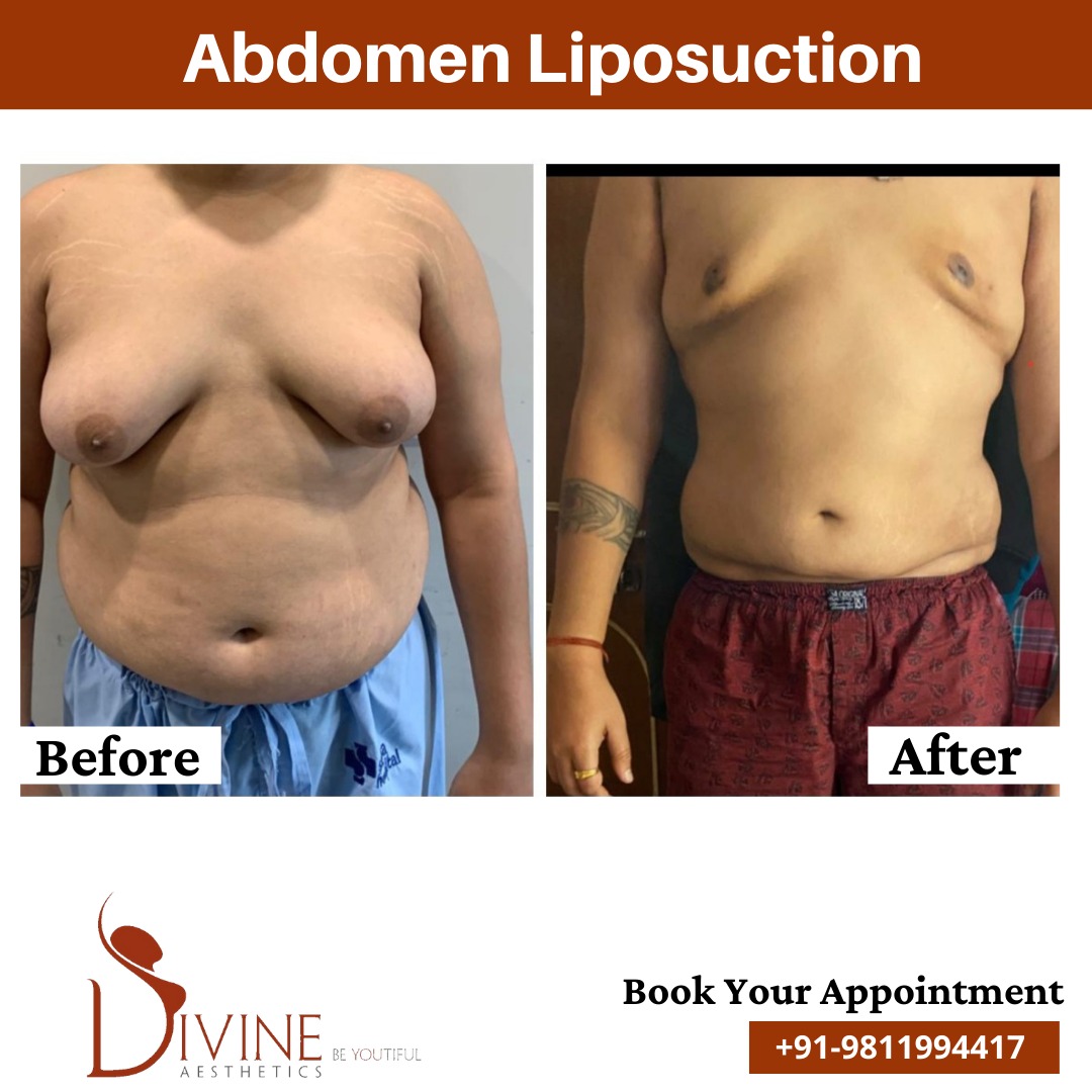 Abdomen Liposuction Before After